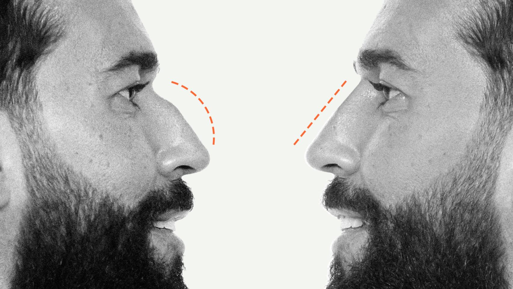 El windsurfista y marido de Anabel Pantoja, Omar Sánchez, antes de someterse a una rinoplastia líquida.