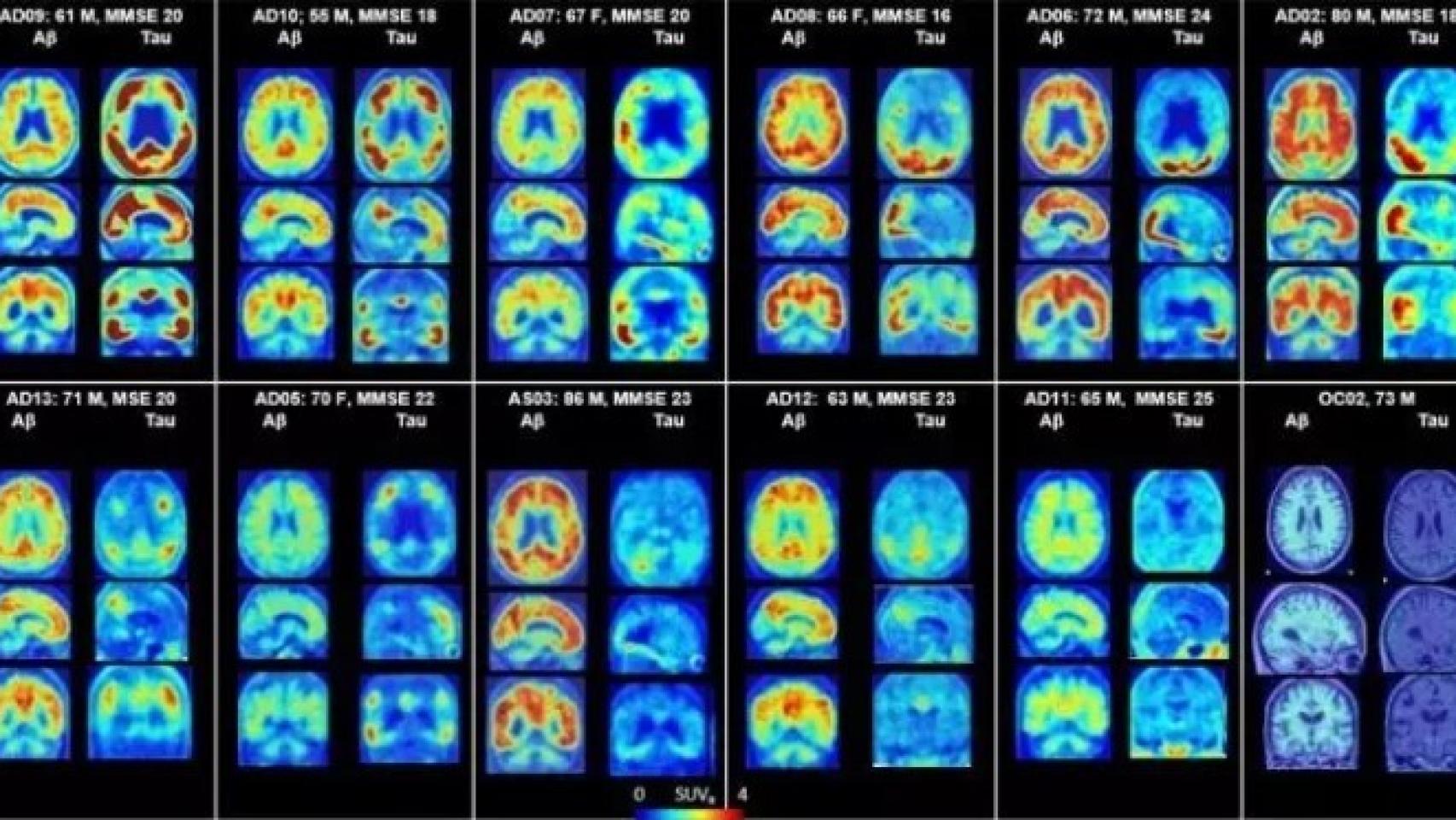 PET del cerebro que muestra placas amiloides y proteínas tau en Alzheimer