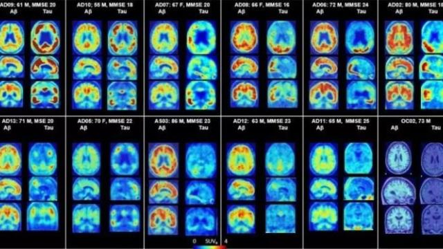 PET del cerebro que muestra placas amiloides y proteínas tau en Alzheimer