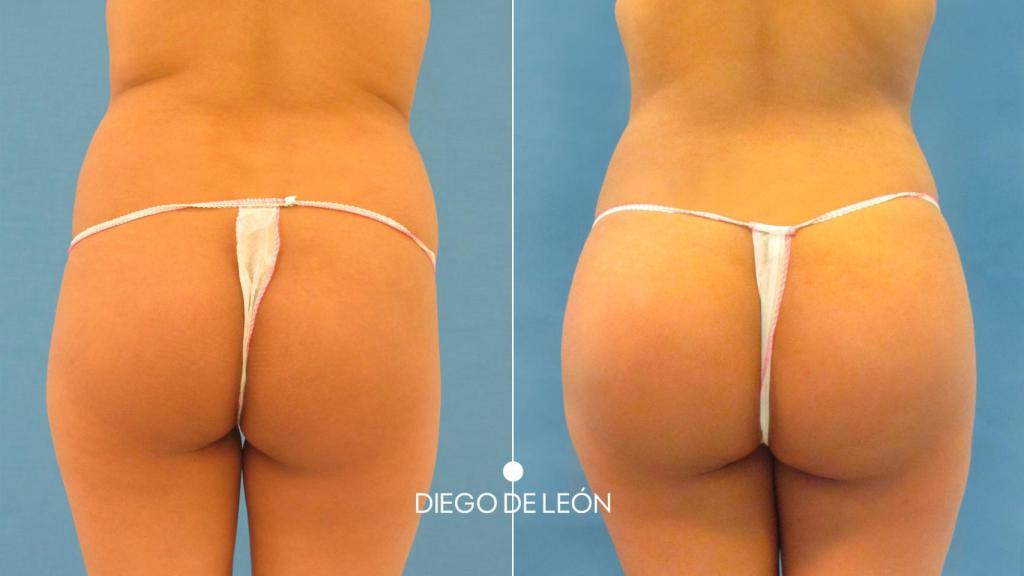 Antes y después de la operación de lipotransferencia.