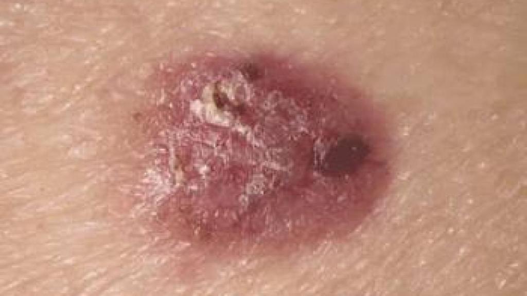 Carcinoma de células basales.