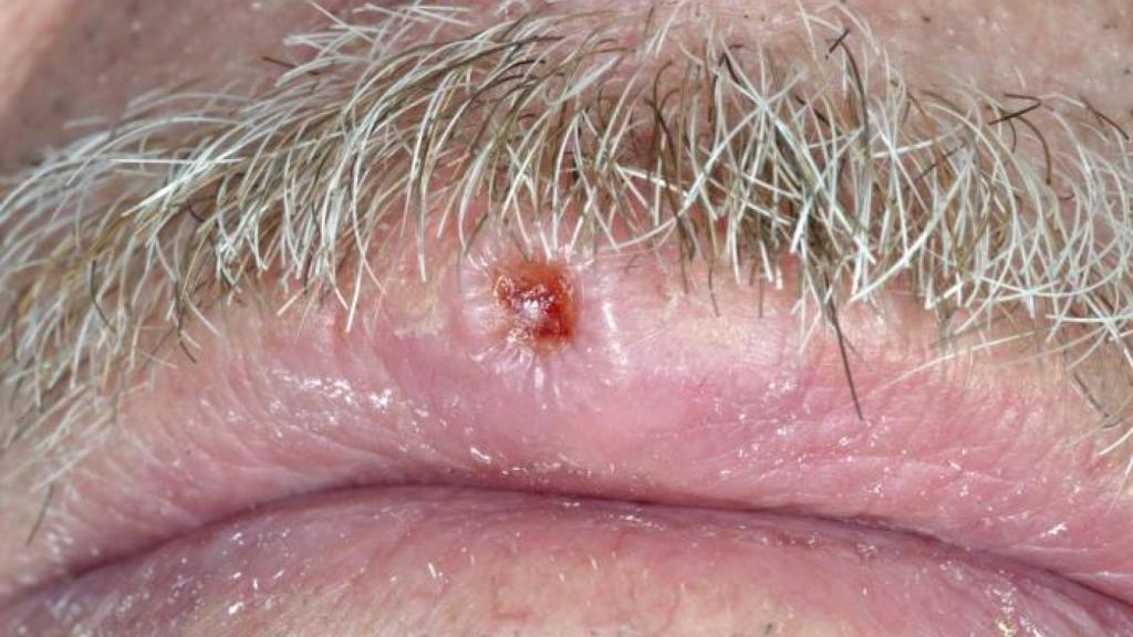 Carcinoma de células escamosas en el labio.