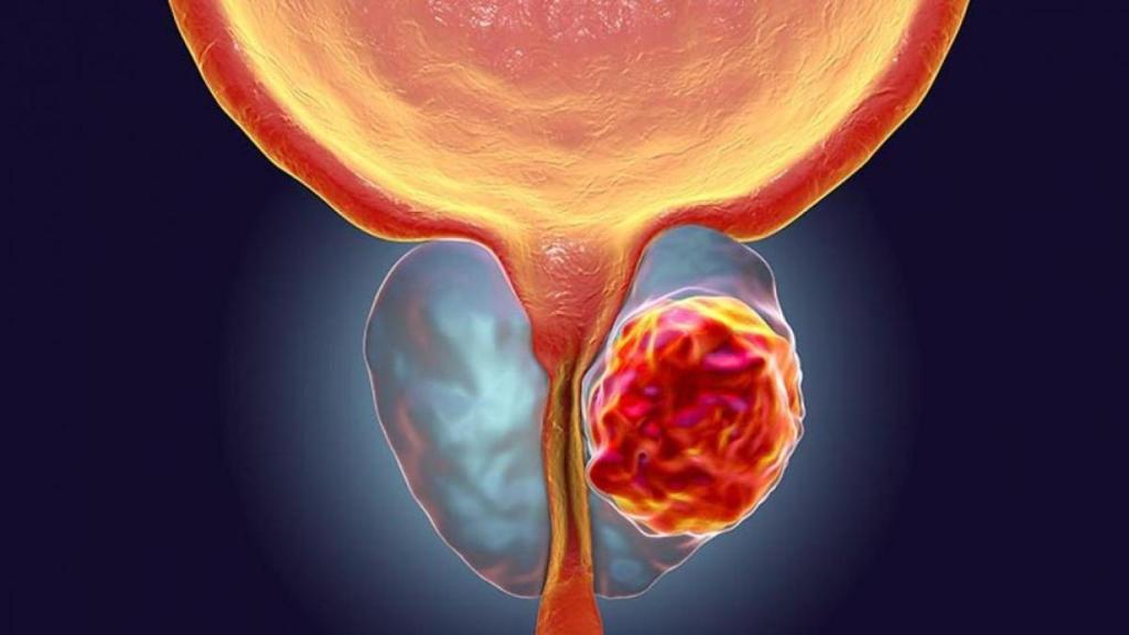 El cáncer de próstata es el más habitual en los hombres.
