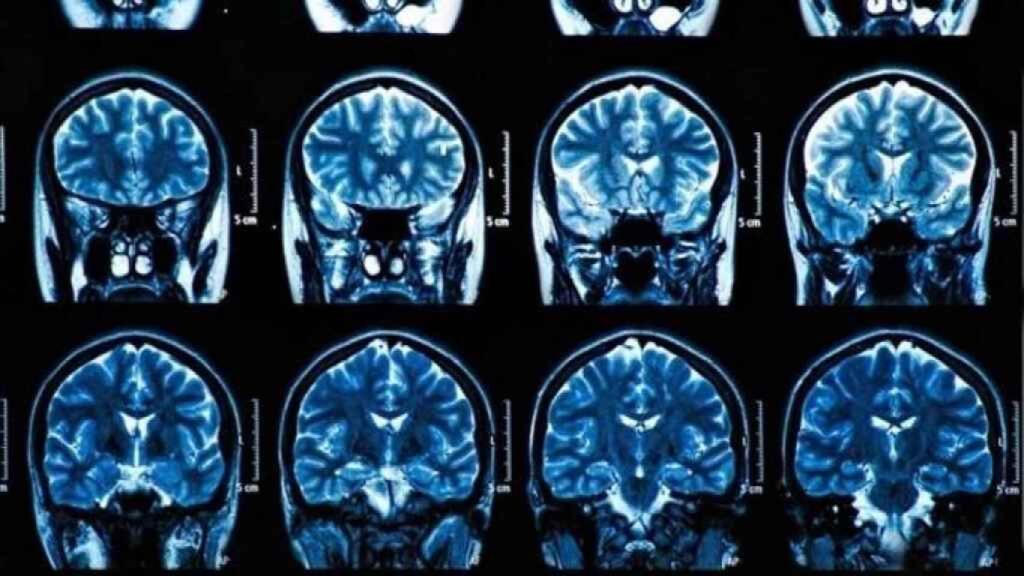 Un escáner cerebral.