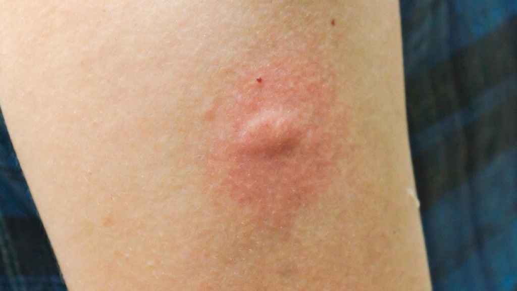 Picadura de mosquito.