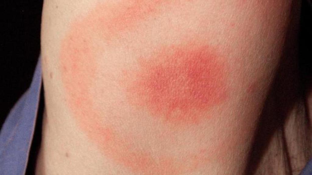 Todo lo que no debes hacer si te pica una garrapata
