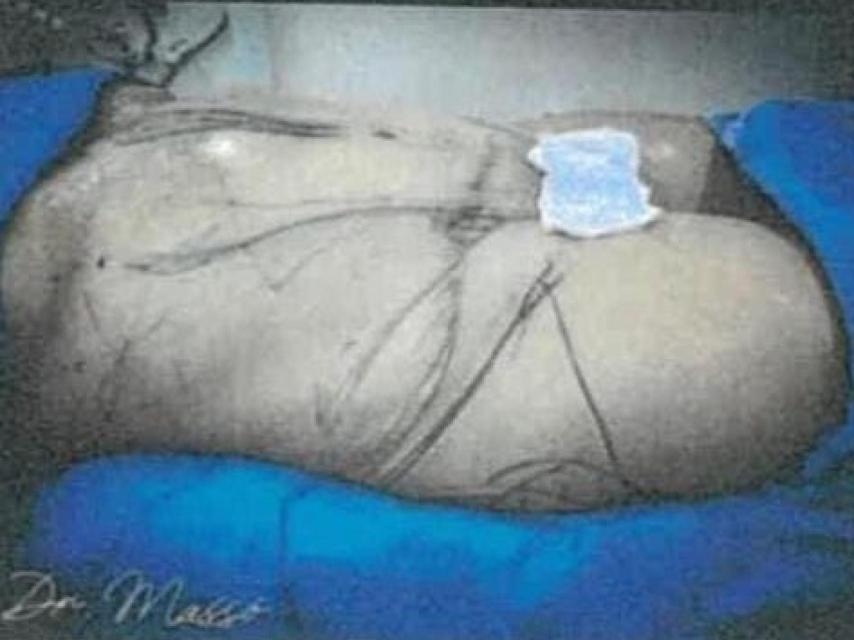 Una de las intervenciones de estética publicadas en Instagram con la firma del cirujano cardiovascular que realizó la lipoescultura a Sara Gómez.