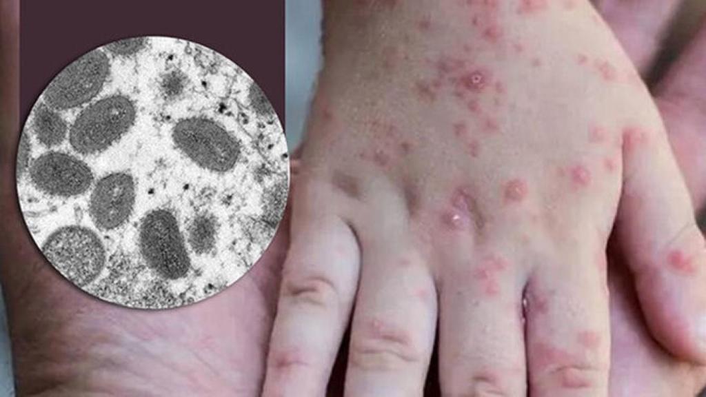 La mano de un niño con lesiones típicas de la viruela del mono.