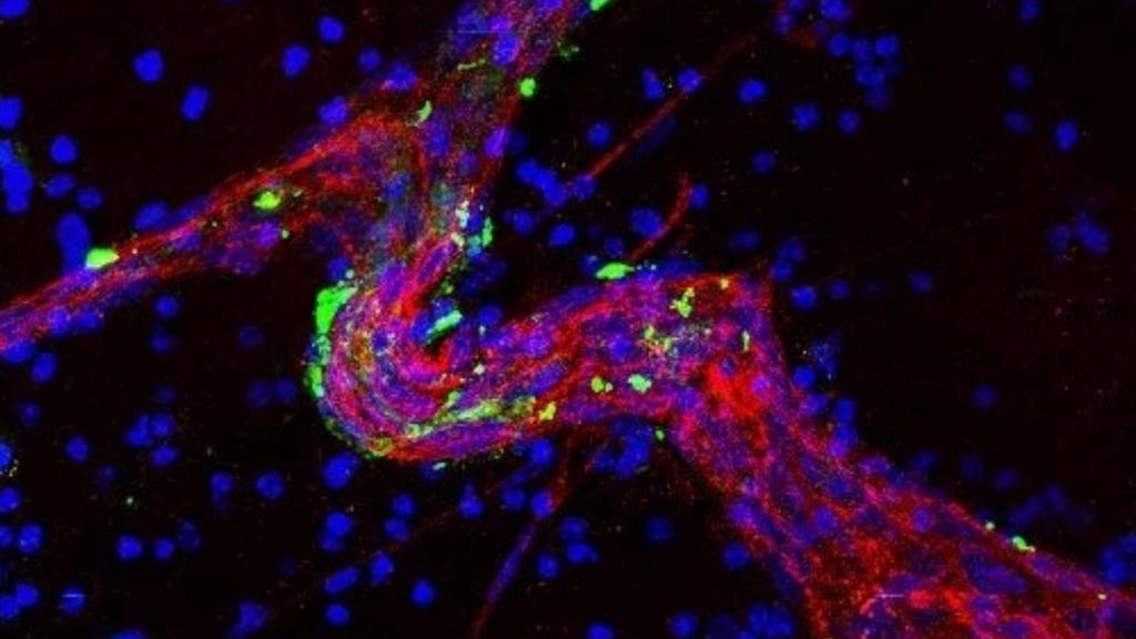 Un gran vaso sanguíneo con células metastásicas cerebrales.