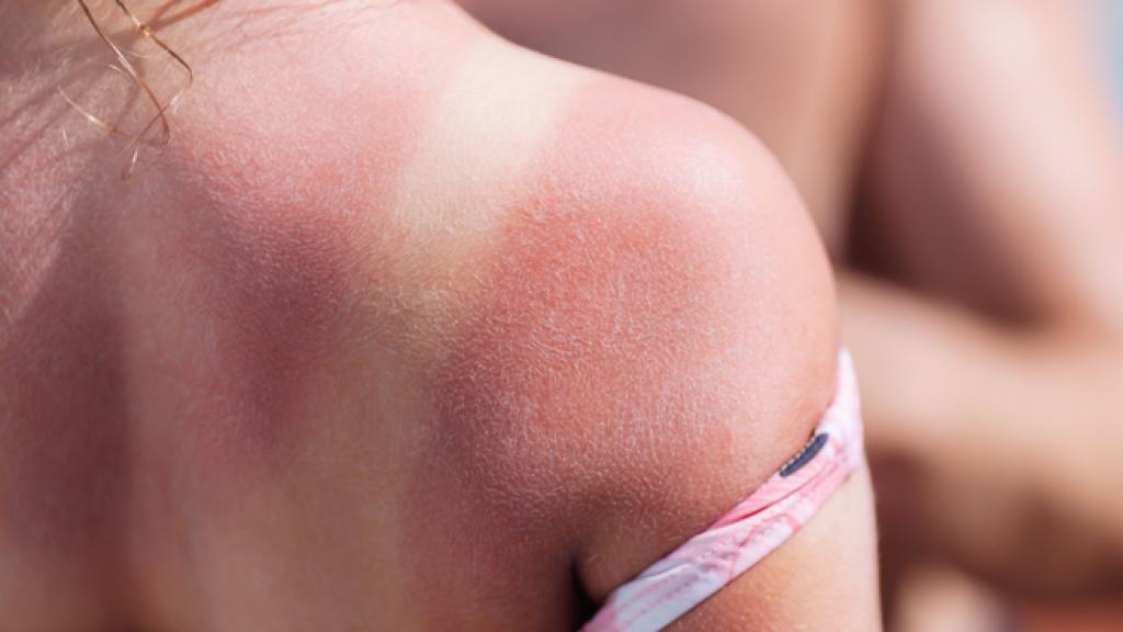 Recupera tu tono: te decimos cómo aclarar la piel quemada por el sol