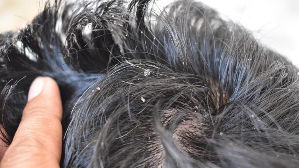 El vinagre para eliminar la caspa de manera natural.