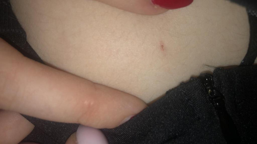 Imagen de archivo del rastro de un posible caso de sumisión química mediante el pinchazo.