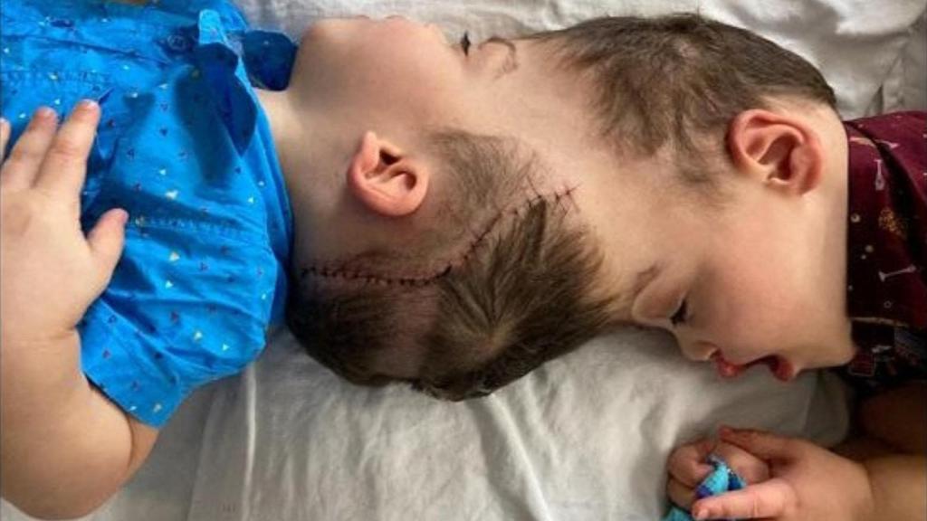 Los pequeños de tres años unidos por el cerebro.