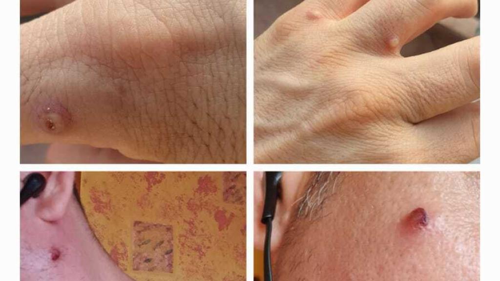 Algunas de las ampollas del cuerpo de Alfredo K.