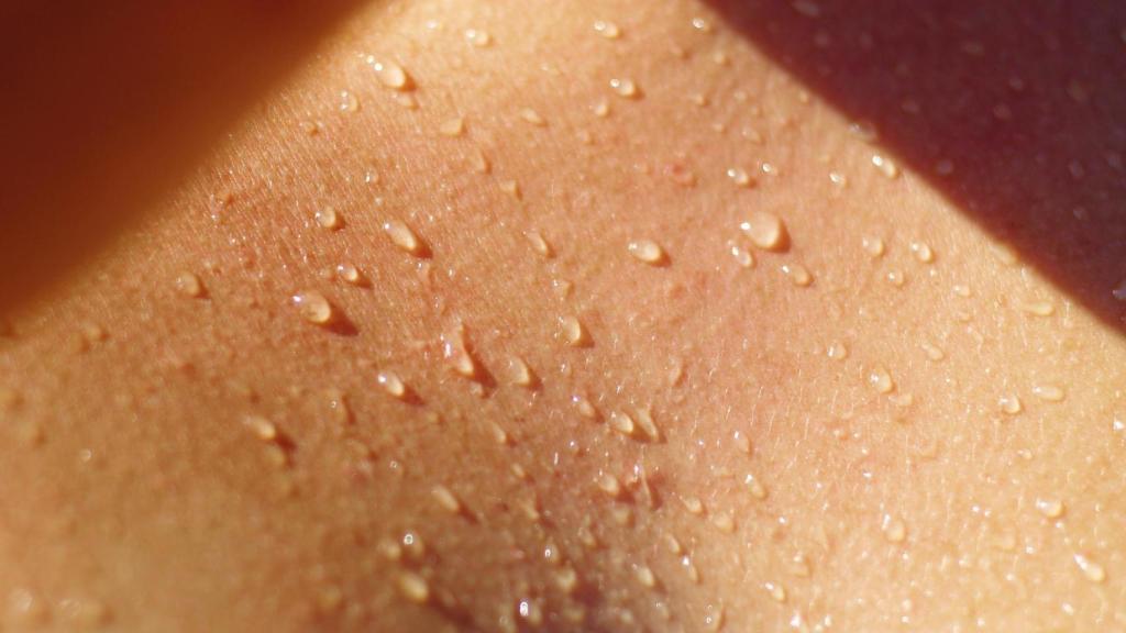 Se calcula que más de un millón de españoles sufre sudoración excesiva, lo que puede llegar a limitar sus interacciones sociales en épocas como el verano.