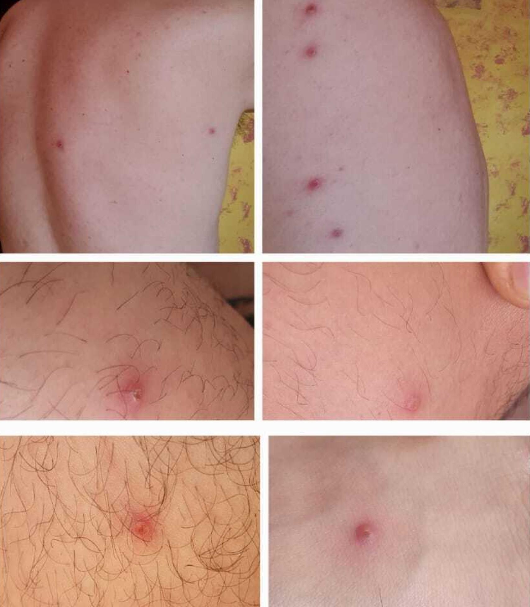 Más lesiones de la viruela del mono en el cuerpo de Alfredo K.