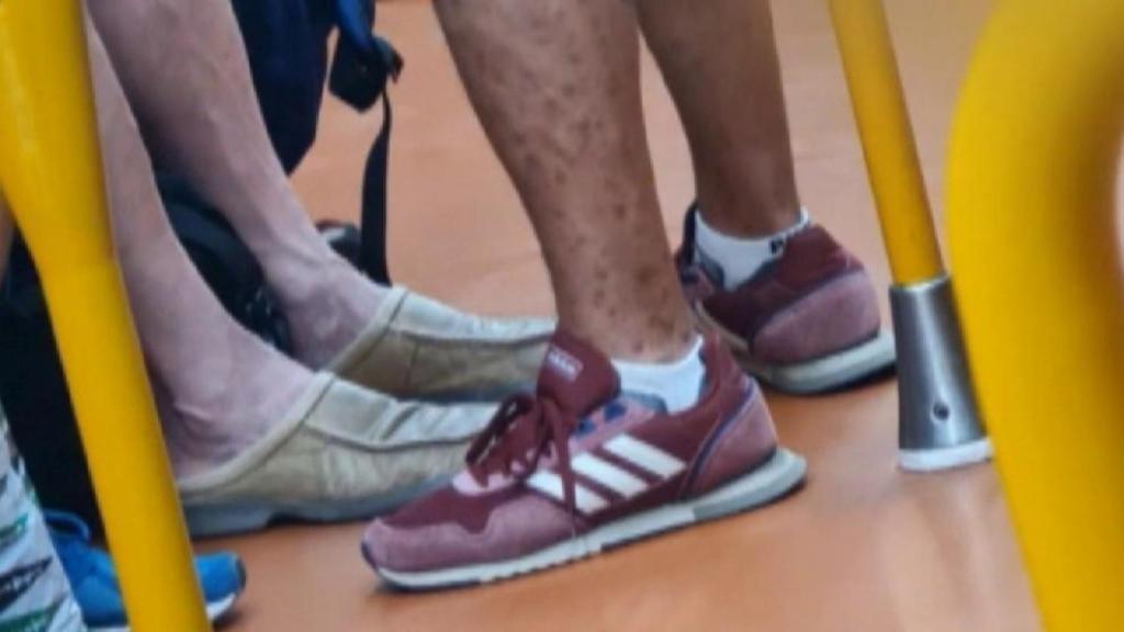 La imagen en la que se acusaba a un hombre con neurofibromatosis de tener viruela del mono.