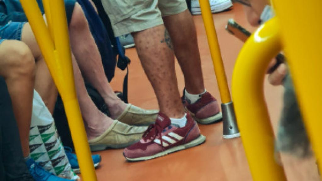 Imagen difundida por Miguel Henriques en la que aparece, presuntamente, un hombre con viruela del mono