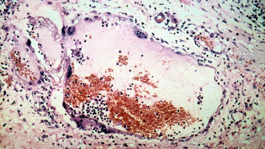 Virus Nipah, un tipo de Henipavirus.