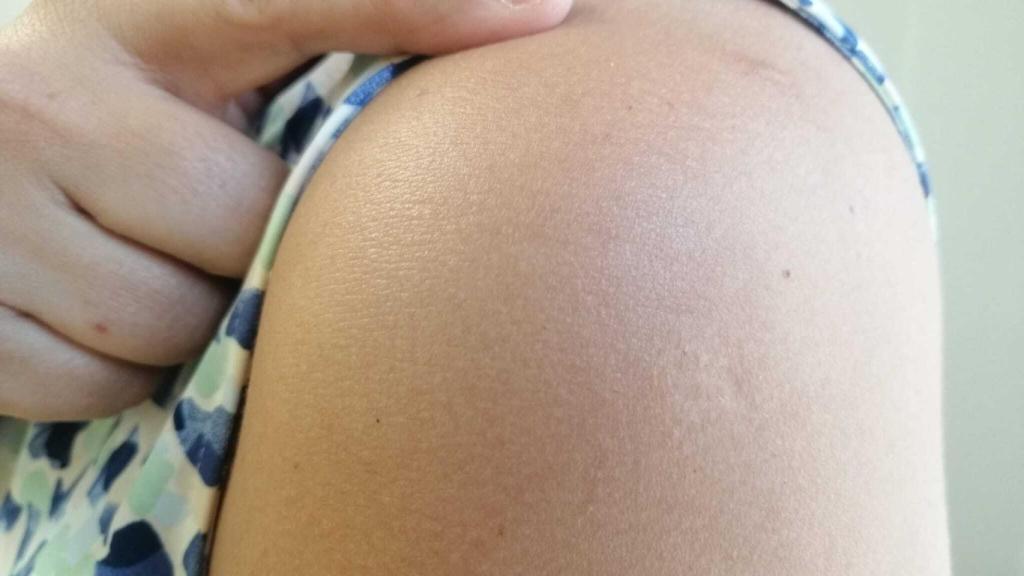 Cicatriz de la vacuna de la viruela común