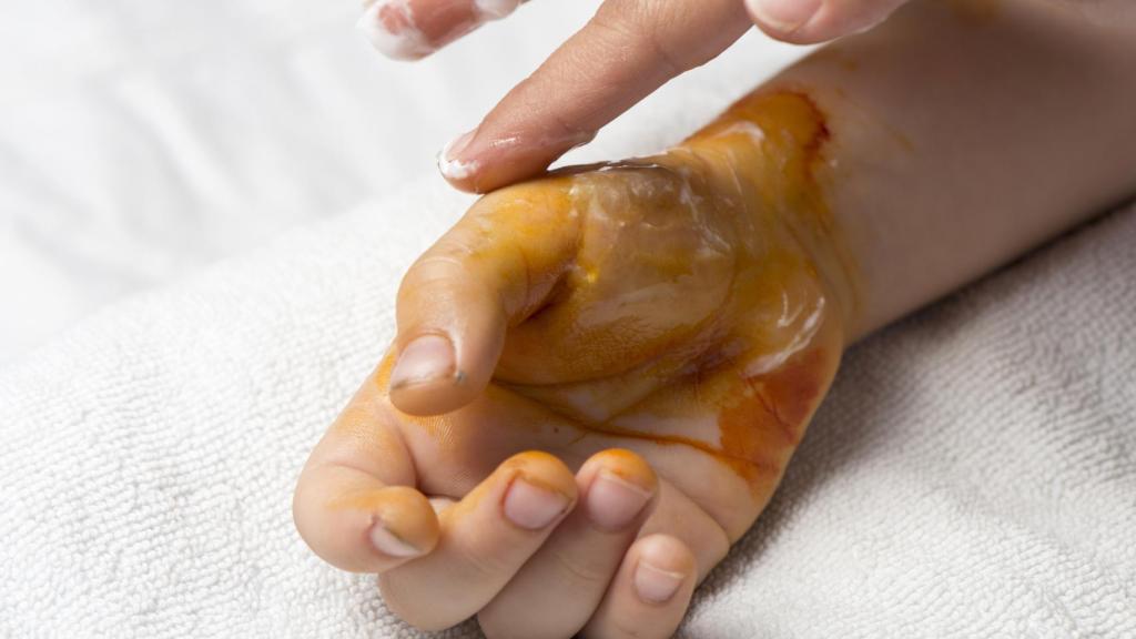 La mano de un niño con quemadura de segundo grado.