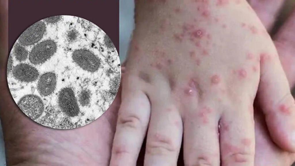 La mano de una persona afectada por la viruela del mono.