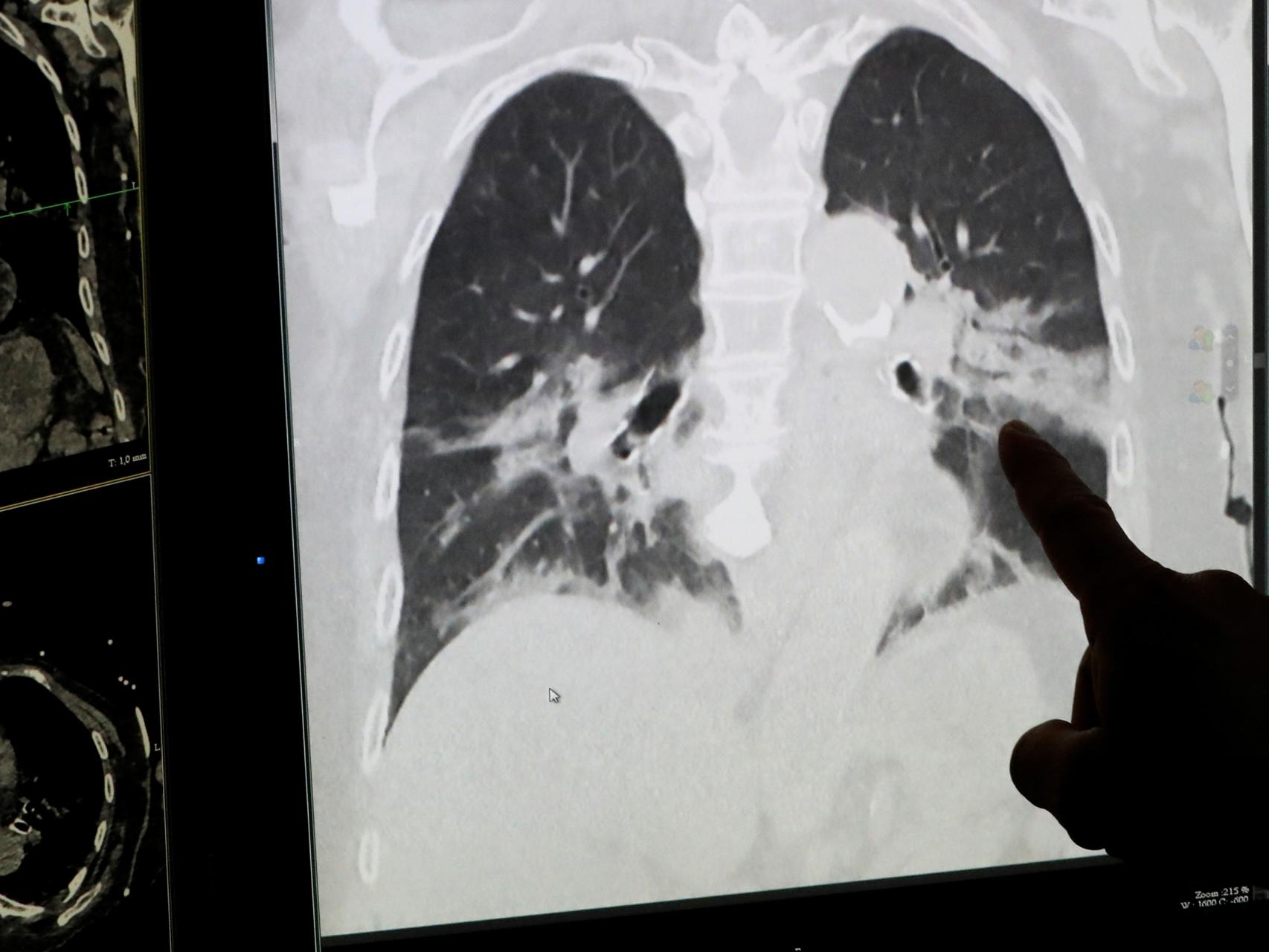 Un radiólogo muestra unos pulmones infectados por Covid-19.