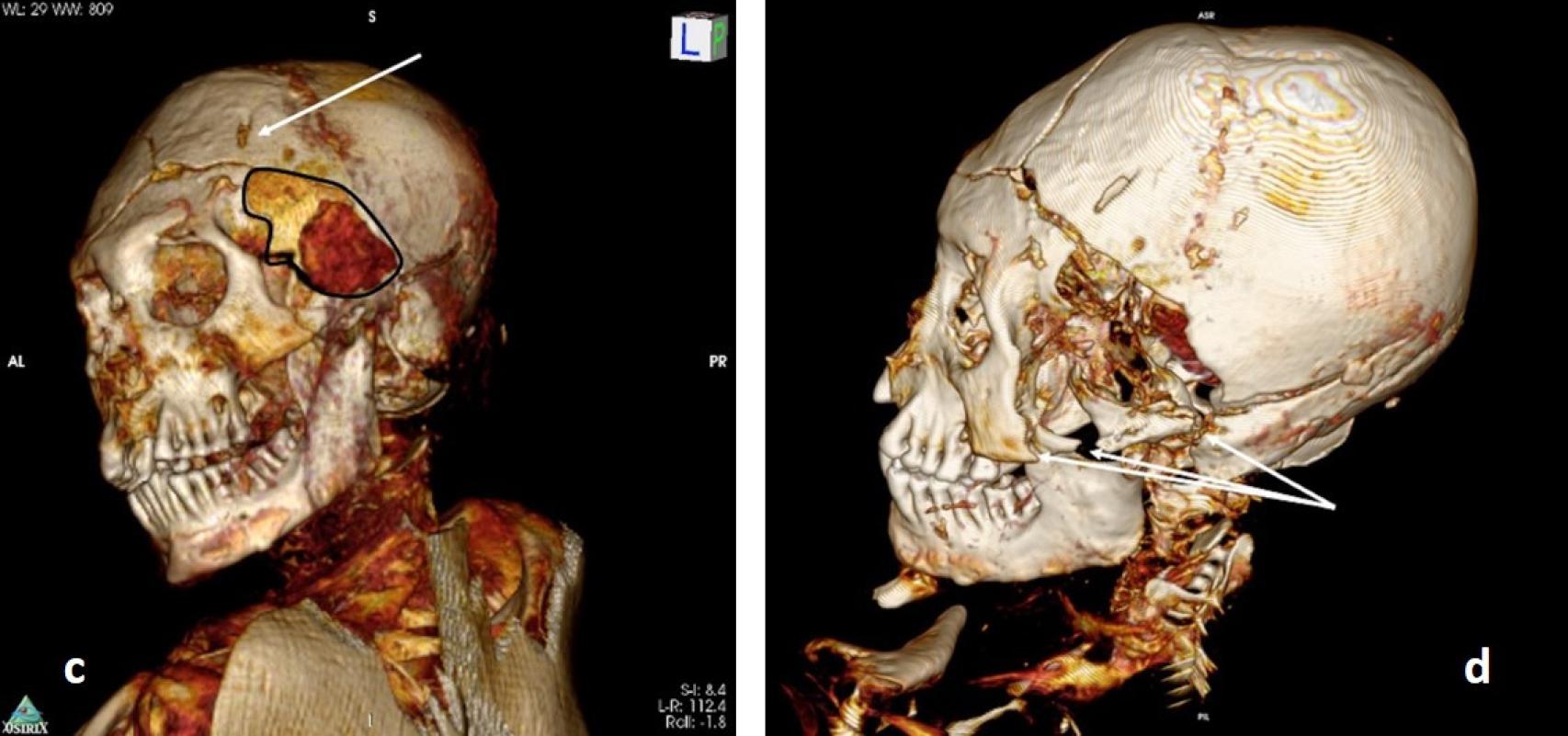 Imagen del escaneado del cráneo de la momia masculina de Delémont.