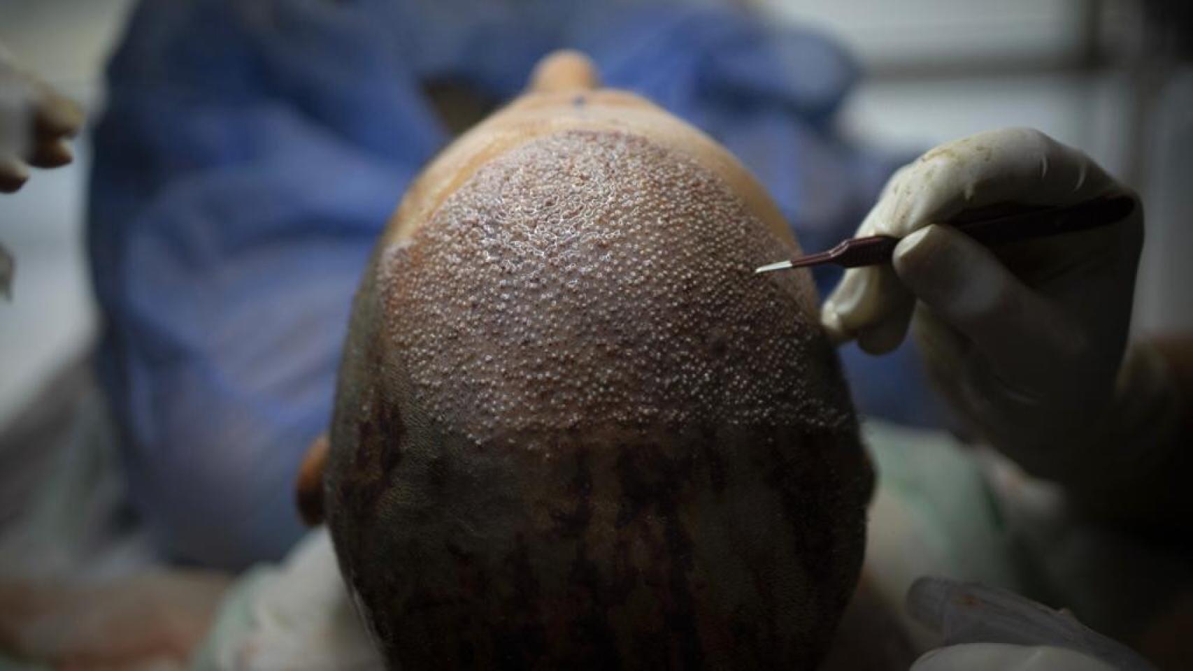 Un paciente, durante una intervención de trasplante capilar.