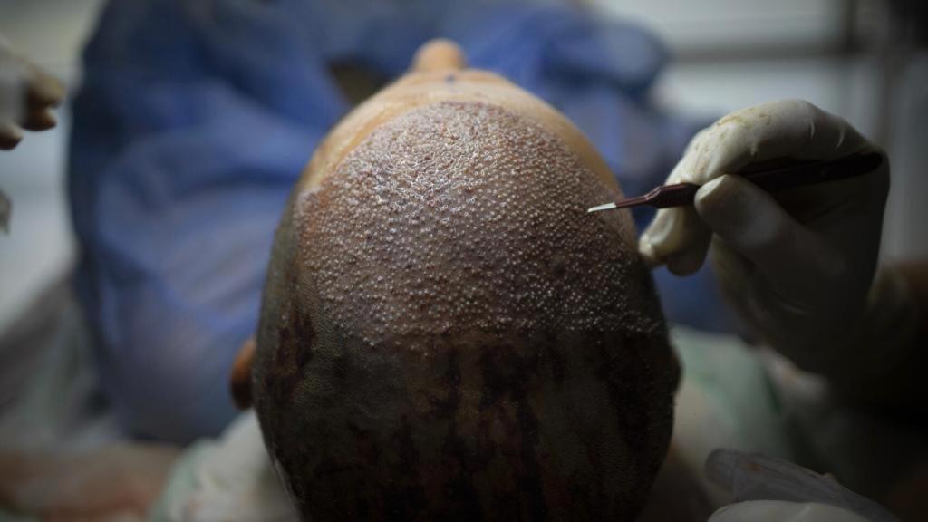 Un paciente, durante una intervención de trasplante capilar.
