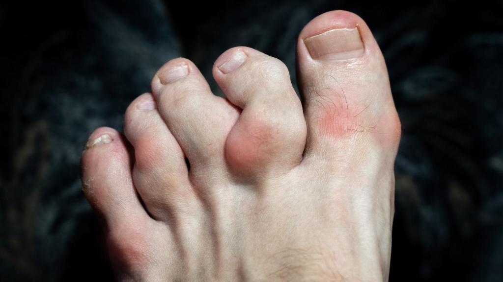 Dedos hinchados y deformados con osteofitos debido a la gota.