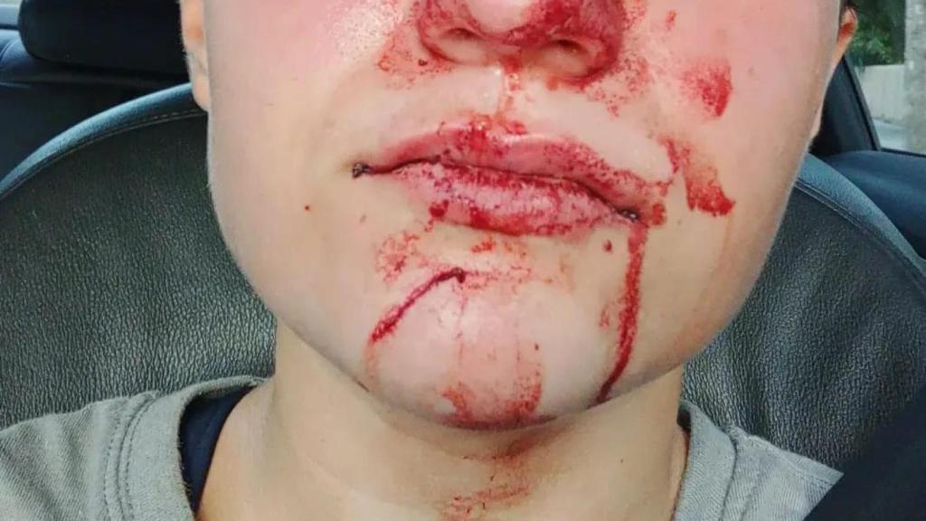 La denunciante, momentos después de la agresión.