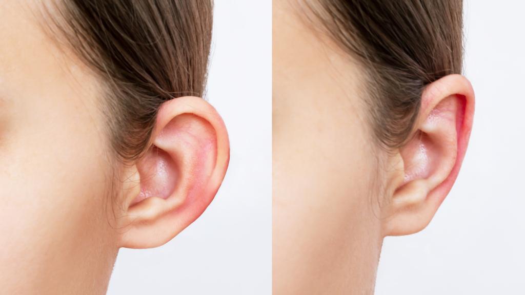 Antes y después de la otoplastia.