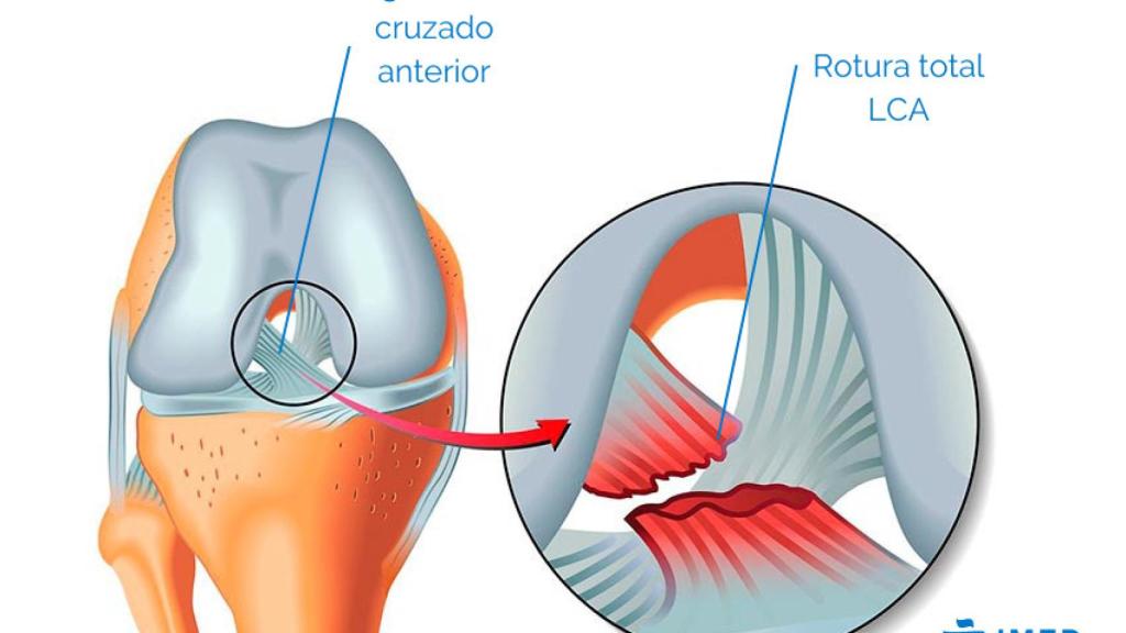 Infografía rotura de ligamento cruzado anterior