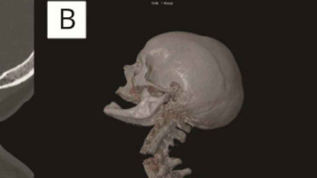 Imagen radiográfica perteneciente al estudio.