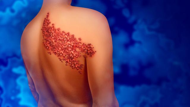 Herpes zóster, un viejo conocido que puede afectar a 1 de cada 3 personas mayores de 50
