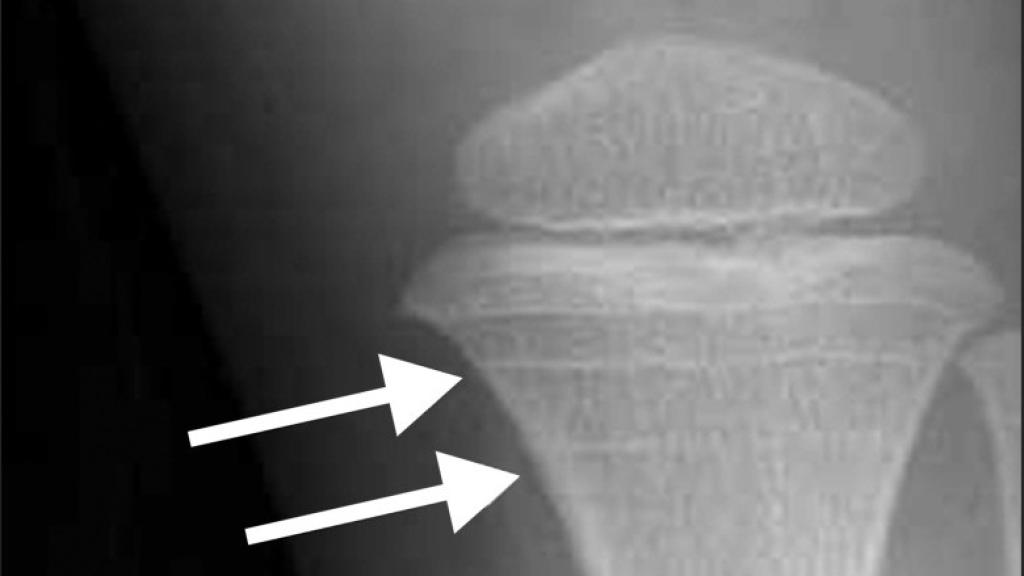 Líneas de Harris publicadas en el trabajo 'Hallazgos incidentales en radiografías de rodilla en niños y adolescentes'.