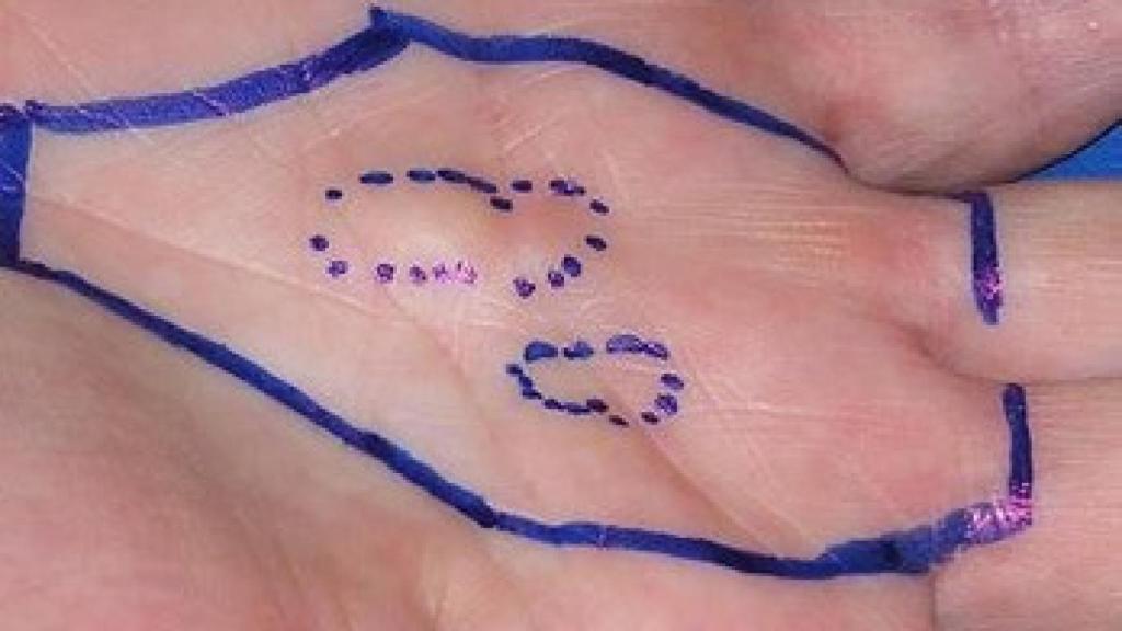 Nódulos de Dupuytren.