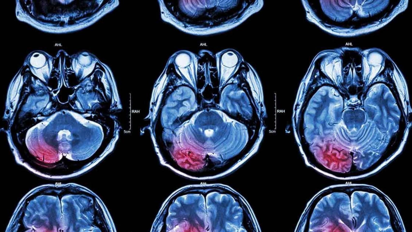 Imagen de un escáner cerebral.
