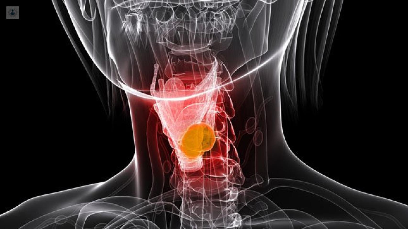 Representación gráfica de un cáncer de faringe.