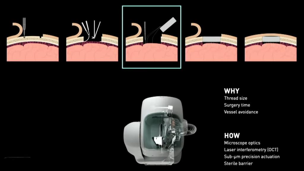 Proceso de implante de Neuralink