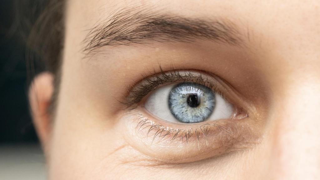 Relleno de ojeras con ácido hialurónico.