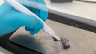 El iKinfe llevando a cabo el análisis de una biopsia