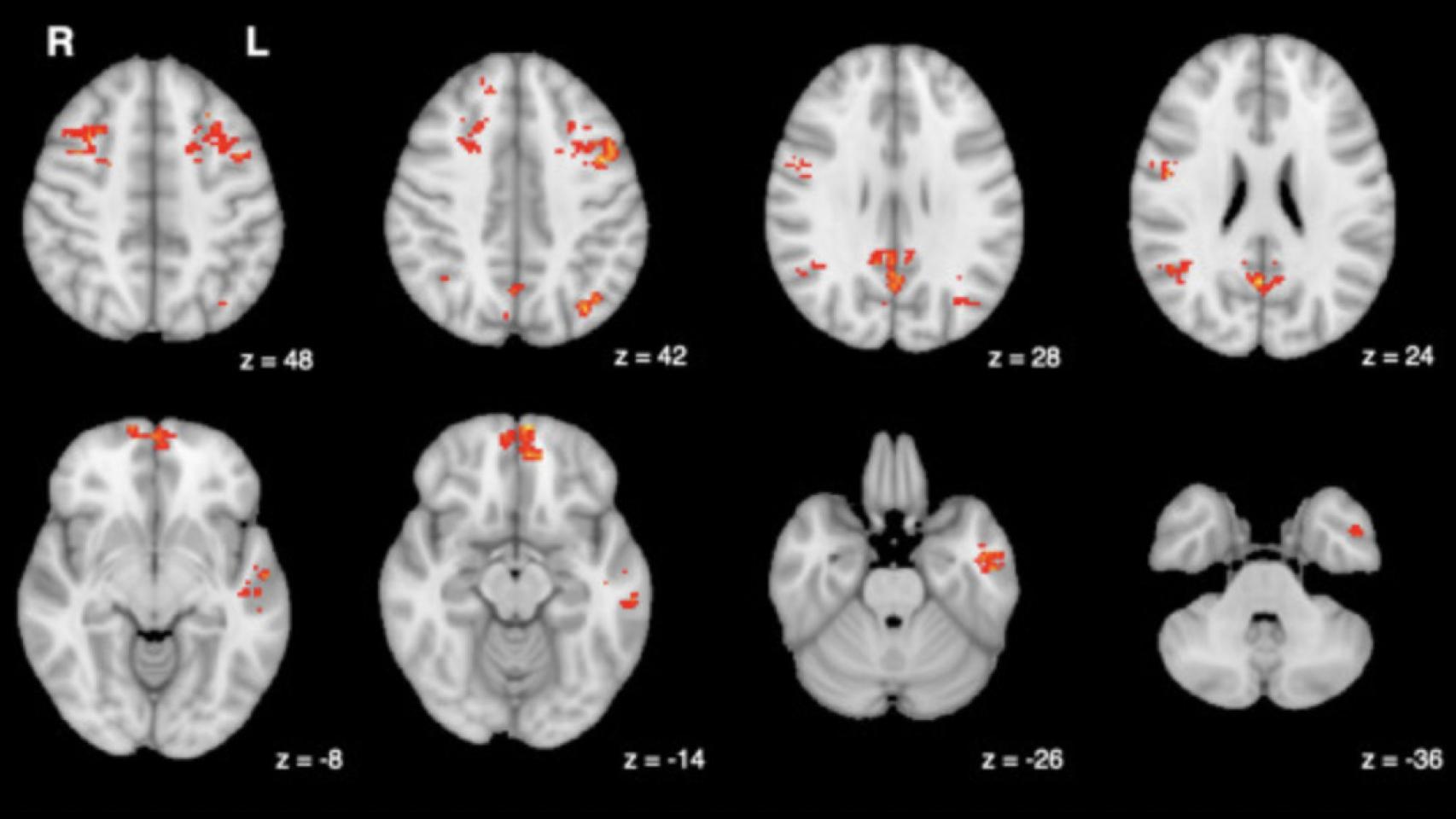 Resultados de las comparaciones a nivel de grupo ( p < 0,05, corregido) con regiones significativas en rojo