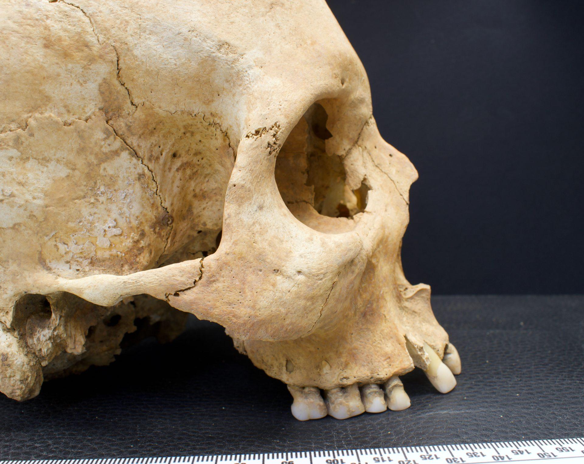 Detalle de una de las calaveras encontradas en la necrópolis de la Catedral (Archivo de Pérez Ramallo)