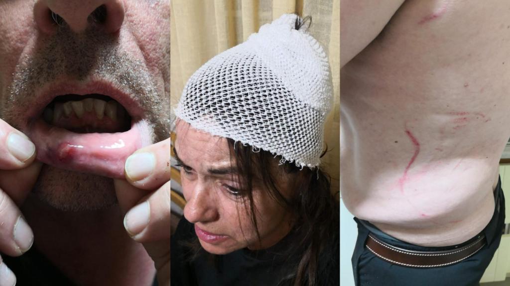 Lesiones sufridas por Javier y Esperanza por la paliza recibida por los narcos.