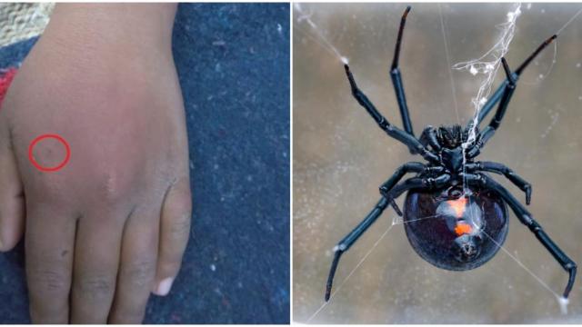 La picadura de una viuda negra sobre la mano de un niño