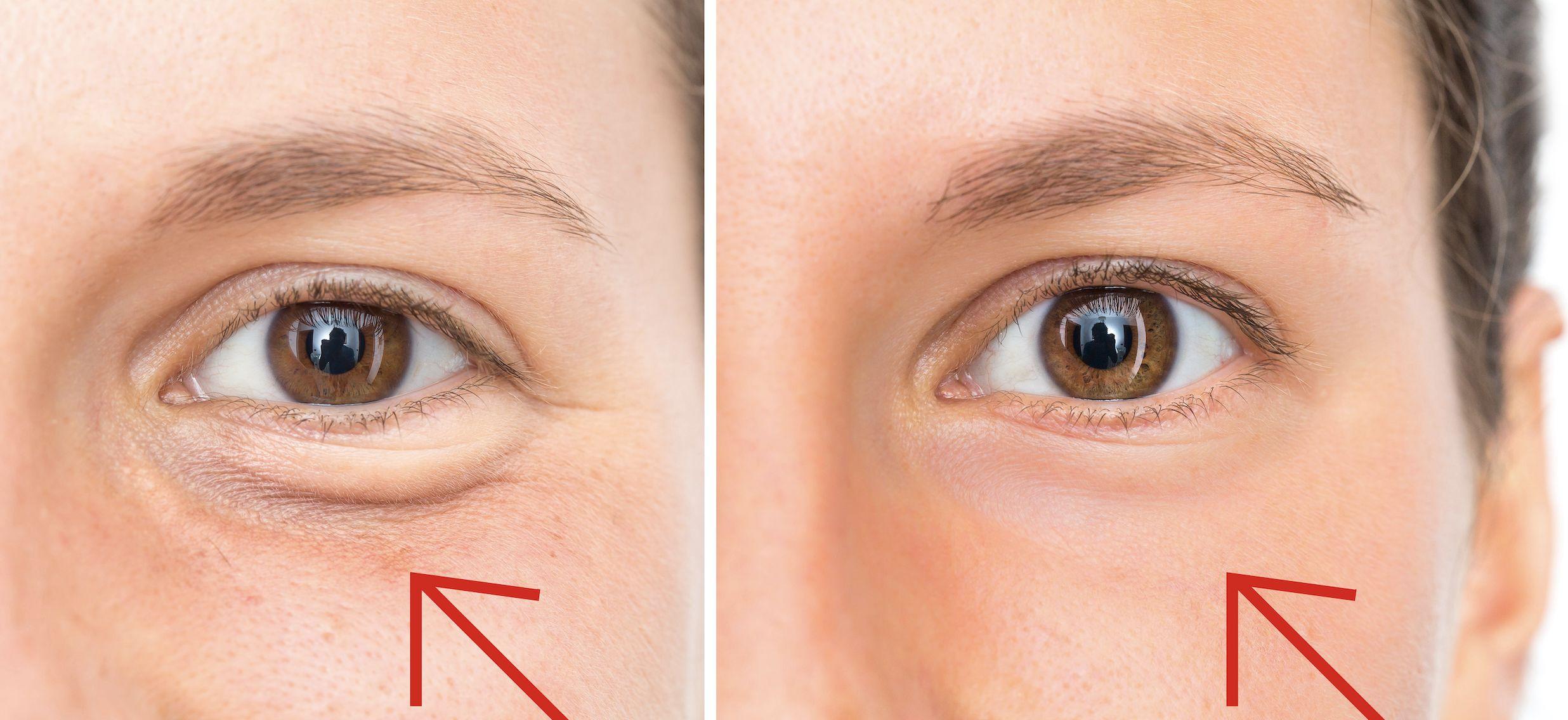 Antes y después del tratamiento antiojeras.