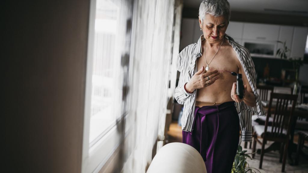 Imagen de archivo de una mujer tras una masectomía. Nikola Stojadinovic iStock