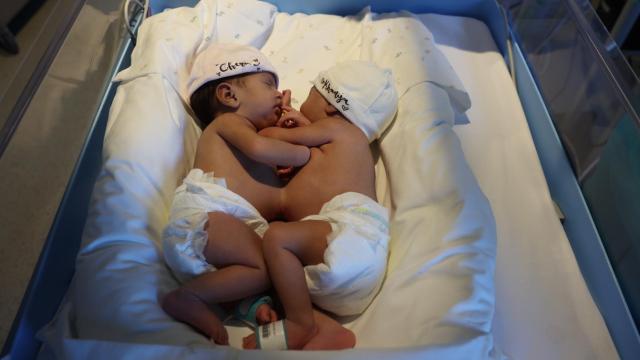 Imagen de las dos gemelas antes de ser separadas.